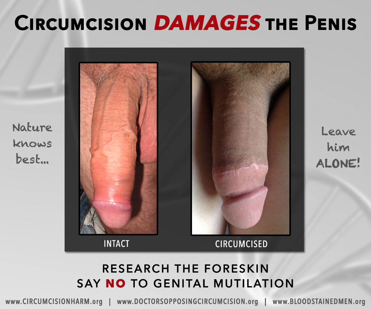 Circumcise Penis 88