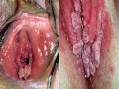 Genital warts on penis