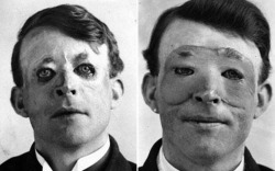 Walter Yeo, premier patient ayant subit une greffe de la peau, 1917.