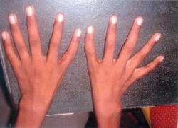 A triphalangeal thumb (TPT) is a congenital malformation where the thumb has three phalanges instead of two.