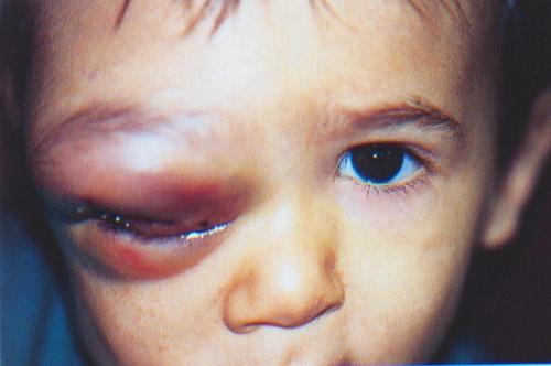 Evaluating the Febrile Patient with a Rash - American ...