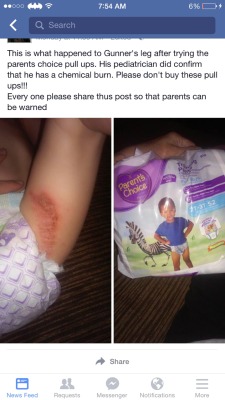 r-the-kawaii:  rosexxxblack:  wanderingobsidian:  These are giving babies chemical burns!!!  Please reblog and spread the news to not buy Parent Choice diapers due to them having harsh chemicals that harm cause terrible burns to little ones like this.