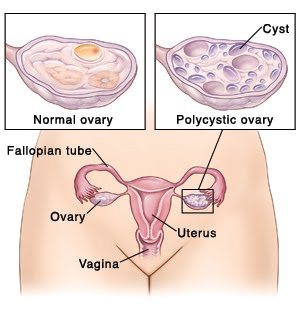 Teratoma ovarian cyst