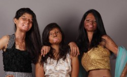Victims Of ‘Acid Attacks’ Join Together For A Fashion Shoot Five brave women, victims of so-called “acid attacks” have joined together for a fashion photo shoot in India. The women are all very different, but share a brutal experience.