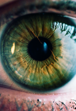 biodyna:   Persistent pupillary membrane.  
