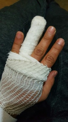 Broken finger 😧😧😧