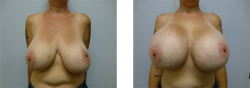 One of the most popular methods of real life breast expansion is simply to get breast enhancement surgery. While it&rsquo;s a little more costly, the results can be phenomenal! And just in time for 2014, thank you for 10000 followers! Happy Boob Year!
