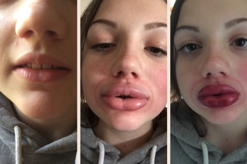 Big lips plastic surgery gone wrong