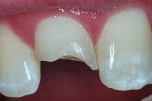 Porcelain crowns front teeth