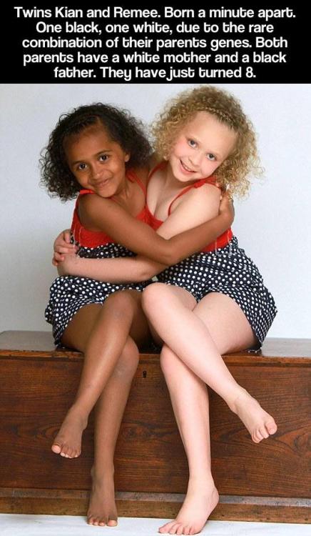 Siamese twin girls teens