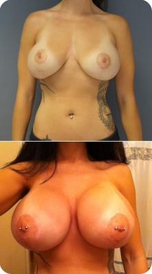 Great implant revision and enlargement. Bigger is better!