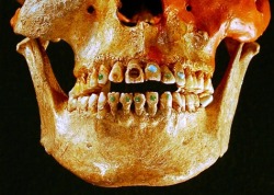 fuckyeahforensics: “Advanced dentistry techniques allowed Native Americans to inset gemstones to their teeth as far back as 2,500 years ago. The early dentists used a drill-like device with a hard stone such as obsidian, which is capable of puncturing