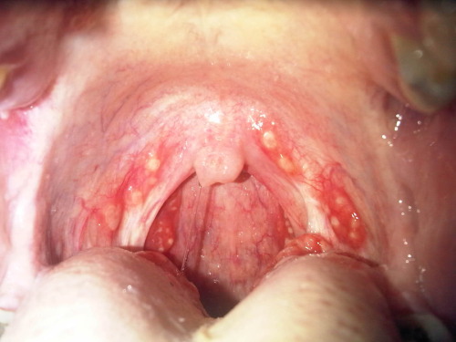 Strep Throat Systoms 27