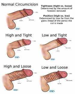 eternalii-famishiis:  circumcisedperfection:  statuscut:  Which style of CIRCUMCISION do you have?  High tight   Normal, though low and tight is my favorite by far. Nothing looks more masculine to me than a bare head attached to a shaft with nothing but