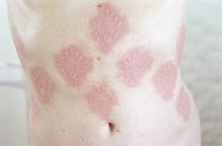 aquaticwonder:  Skin, Ariana Russell  Ariana Page Russell’s skin blushes easily. The slightest scratch will become visible as swollen line on pink skin. Due to a condition called dermatographia, her immune system releases excessive amounts of histamine,