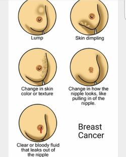 yourstudymate:  Breast cancer is the most common cancer in females. Most of the time it is not hereditary. Risk factors generally involve increased estrogen levels which in turn increases breast cancer risk by increasing estrogen hormone receptor positive