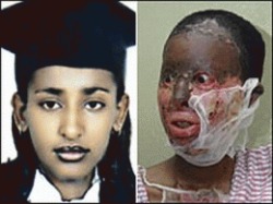 Twenty-one-year-old woman Kamilat Mehdi’s life was changed forever when a stalker threw sulphuric acid in her face. Ismail, Kamilat’s brother said: “The man who attacked her stalked her for a few years. He gave her a hard time but she didn’t tell