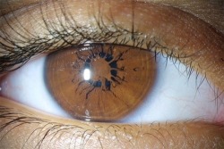 ewok-gia:  Persistent pupillary membrane (PPM) is a condition of the eye involving remnants of a fetal membrane that persist as strands of tissue crossing the pupil. 