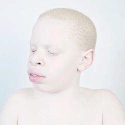 oau:  Snow White by Sanne de Wilde   &ldquo;Like photographic material, people with albinism are light sensitive. Light leaves an irreversible imprint on their body. This whiteness that makes them stand out, when captured in an image, almost makes them