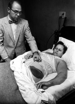 corporisfabrica:  1954: the giant bruise just above the hip of Ann Hodges, pictured, is the result of the only confirmed human meteorite strike. The impact caused quite the stir in the city of Slyacauga, Alabama when it was made, but despite that rock
