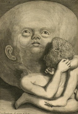Frederik Ruysch and Cornelis Huyberts - Infant with hydrocephalus, from Thesaurus anatomicus, 1701