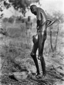 Sudanese man with elephantitis. Via Collection of Old Photos.