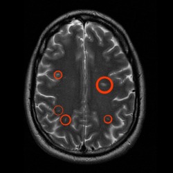 A brain exhibiting lesions caused by Multiple Sclerosis. Go to this link to learn more: http://www.nationalmssociety.org/