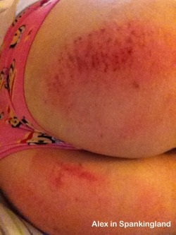 Extreme bruise closeup! An older one of me having been spanked by Malignus. 