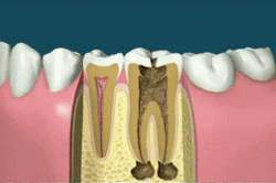 sixpenceee:ROOT CANAL PROCEDUREA root canal is a procedure done to help repair a tooth that’s been severely decayed or infected.  A root canal procedure is performed when the nerve of the tooth becomes infected or the pulp becomes damaged. During the