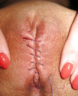pussymodsgaloreBDSM pain games. Her pussy sewn shut with needle and thread. Enforced chastity.In some of these scenes existing piercing holes are used, therefore no pain, but not here, ouch!