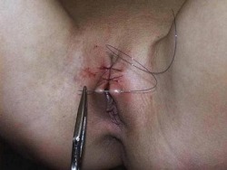 pussymodsgalore   Sewing her pussy shut. Temporary infibulation. Some like the idea of their pussy being closed up, and could even do this to themselves, for others they may be sewn up during a BDSM scene. In either case, the area should first be made
