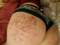 My butt bruises beautifully.