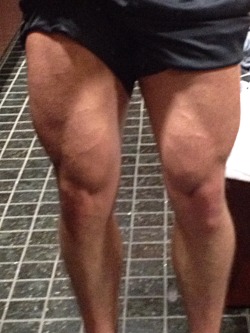 First time ever havin leg veins. Exciting.