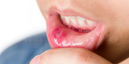 Ulcer sores on skin