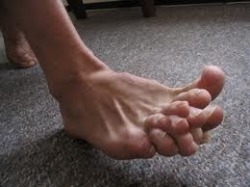deformed toes
