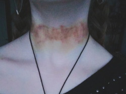 amethystcrescent:daddy said i needed a new choker so he made one out of hickeys. i love it, but it’s fading out so quickly, i guess, daddy will have to make a new one.