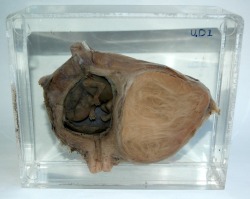 This particular specimen belongs to UCL Pathology Collections, and is currently on display in the Foreign Bodies exhibition. The anonymous woman patient underwent a hysterectomy most likely sometime in the early 20th century, in order to remove the sizabl