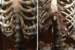 From the MutterMuseum - the deformed ribcage of a woman who wore corsets vs a normal ribcage