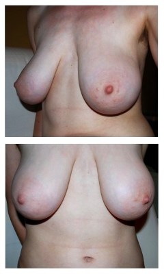 ourbreasts:  Anonymous Submission: Hi. I am 22 years old, and I recently lost a lot of weight in both muscle and fat, so my breasts sag. It’s kind of cute. I have never had a child and my bra size is 70F(EUR) or 32F/32E (US/UK). I used to wish for large