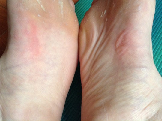 feet blisters