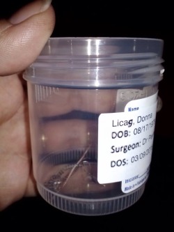 mrsverges:So these are the poisonous coils I had taken out of me Monday, along with my fulopian tubes. These are called Essure permanent birth control coils. I had them placed 6weeks after having SAV via c-section. So once the side effects started only
