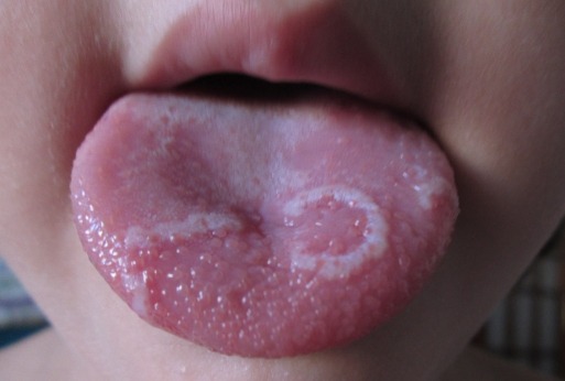 White bumps on back of tongue sex picture club