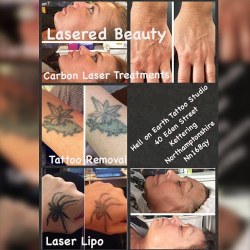 @laseredbeauty  #followforfollow  #kettering #laserlipo #carbonlaser #tattoo #tattooremoval #follow #tattooregret comment for bookings by charleyatwell