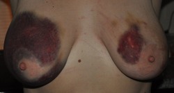 otherrealm:  We both loved the tit bruising, the one on the left kept growing after a tit punching session the first day.  