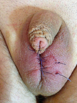 mistresszena:  Another successful double op- suture chastity &amp; sex change. Foreskin sewn up, Balls sewn shut, makes a nice pussy, cock also sewn to pussy so ‘she’ now pees down and has to sit on the loo to pee.