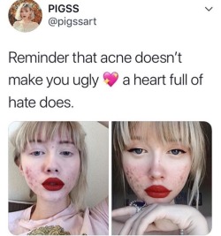 iwilleatyourenglish: miss-andrie:  I’m sure I’d feel the same way if I was a skinny white girl with blue eyes and blonde hair   this girl posted a picture featuring her cystic acne uncovered, something that’s extremely stigmatized, in order to make