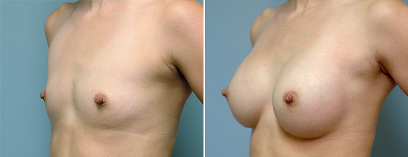 Best breast implants