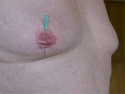 needle through nip