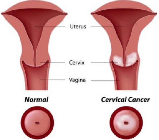 Cervical cancer stages hard porn pictures
