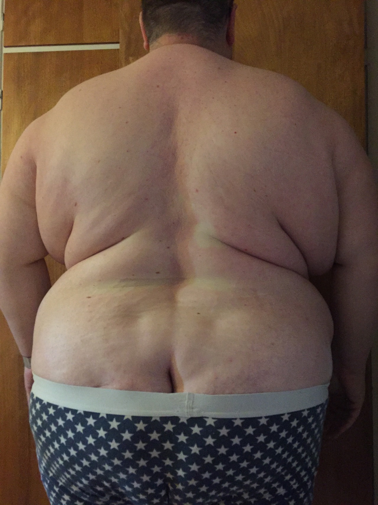 Liposuction back fat bra
